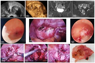 ACUM, an easily underdiagnosed cause of dysmenorrhea—A case report